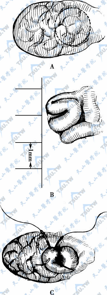 在附睾尾外膜上开个小口以游离一条膨大的附睾管（A）。尾部附睾管的测量（B）。两条显微缝线纵形穿过附睾管（C）