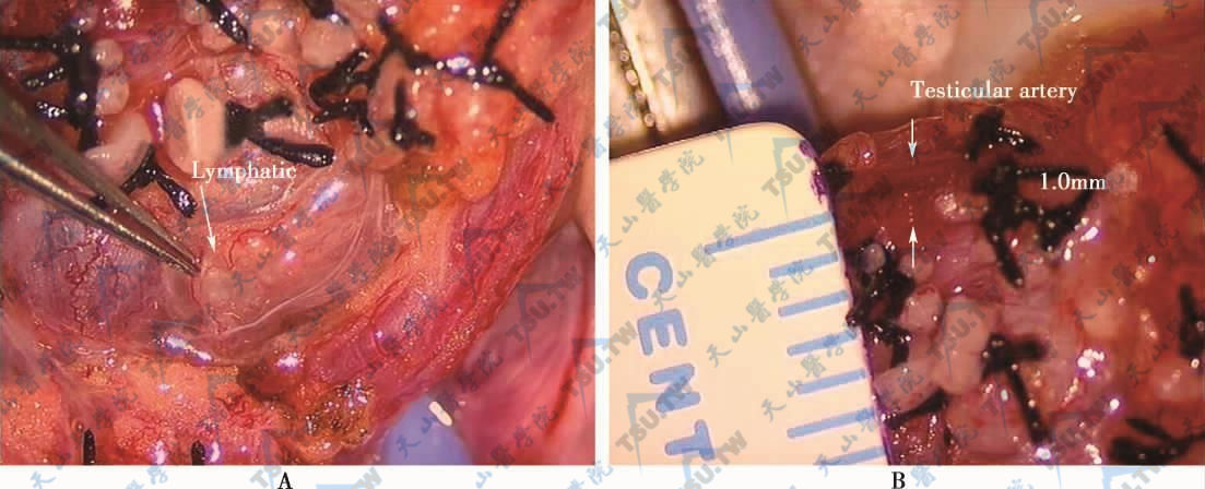 显微男科手术与开放手术和微创手术的比较