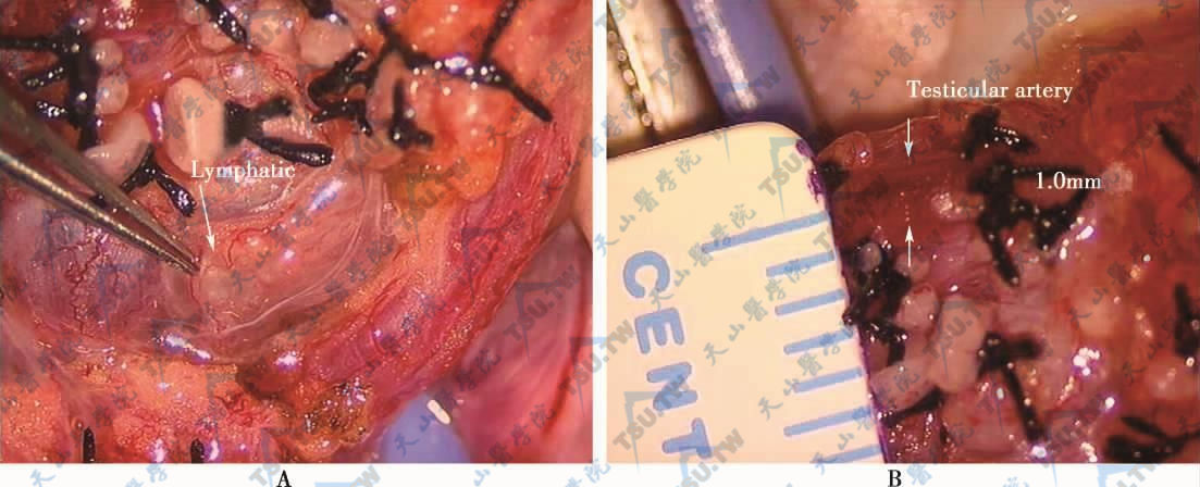 显微镜下，淋巴管、睾丸动脉等细小组织可以清晰辨认
