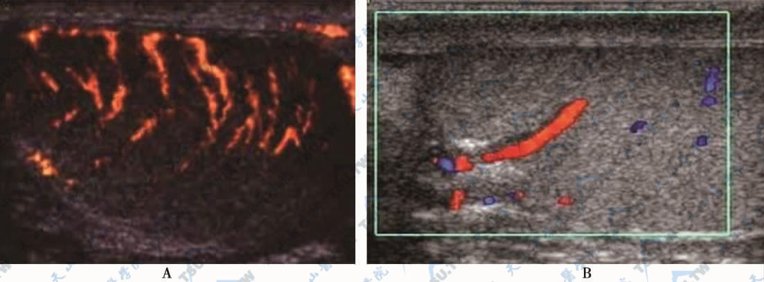 正常睾丸血流声像图  A．睾丸包膜动脉　B．睾丸向心动脉