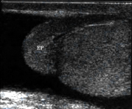 正常附睾声像图