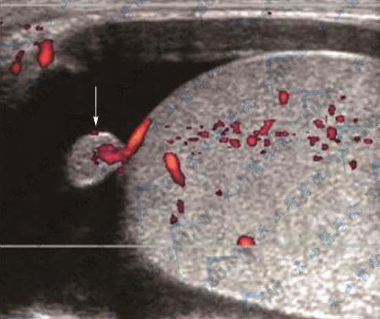 正常阴囊内容物及阴茎超声声像图表现
