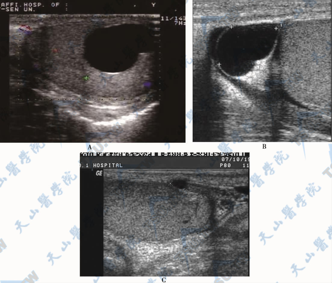 A．睾丸囊肿声像图　B．附睾囊肿声像图　C．白膜囊肿声像图