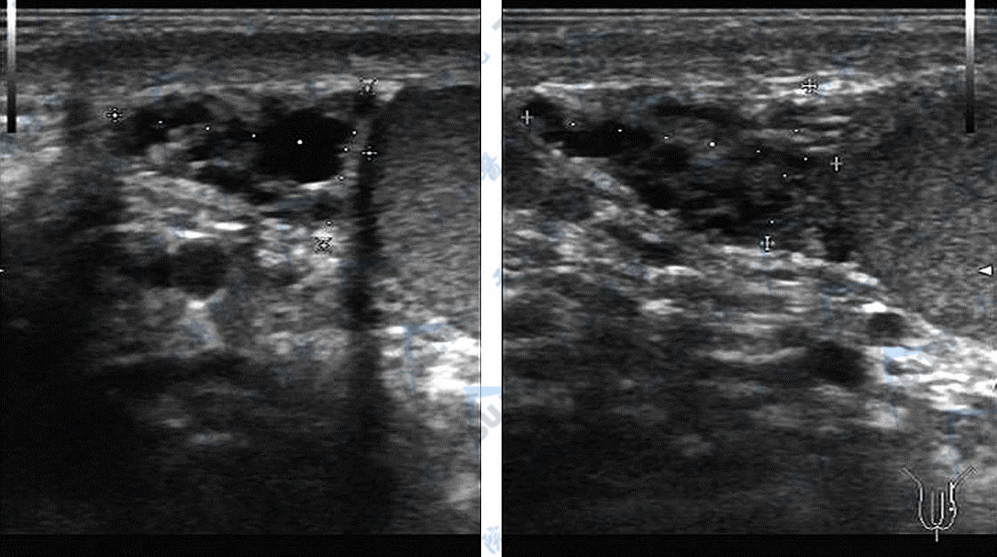 克氏综合征附睾声像图