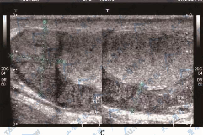 附睾梗阻合并炎症声像图