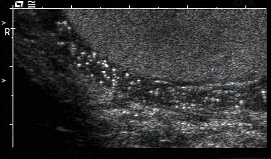 附睾梗阻特殊征象声像图
