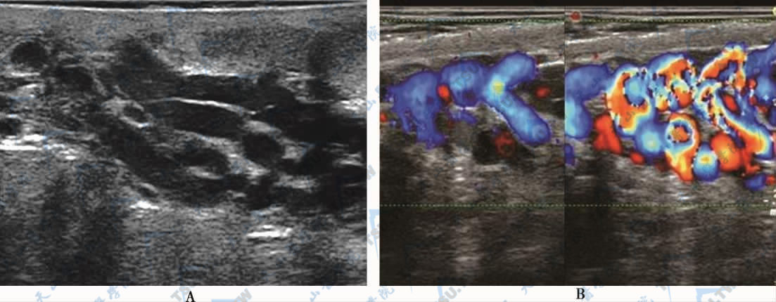 精索静脉曲张声像图