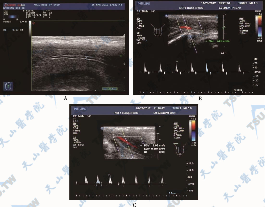 正常阴茎海绵体动脉频谱图