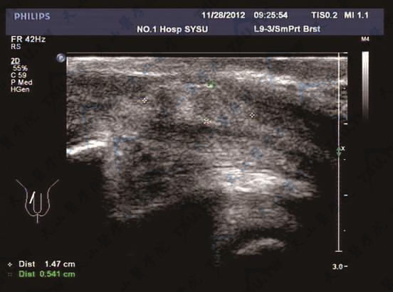 阴茎硬结声像图