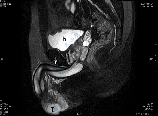 矢状面T2WI脂肪抑制成像，显示阴茎（→）、前列腺、膀胱（b）、阴囊、睾丸（T）