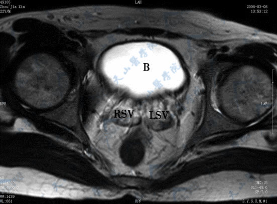 横断面T2WI示左、右精囊（LSV、RSV）、膀胱（B）
