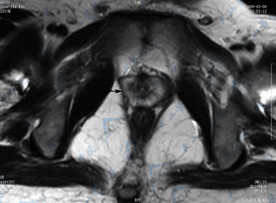 横断面T2WI示前列腺外周带（→）呈高信号，中央带呈低信号