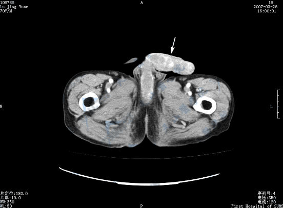 横断面CT增强扫描示阴茎癌（→）不均匀强化，边界不清
