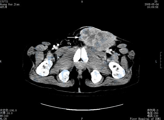 横断面CT增强扫描示阴茎癌并左侧腹股沟淋巴结转移（→）