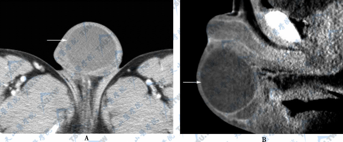 示右侧阴囊积液（→）  A．横断面CT增强扫描　B．矢状面CT增强扫描