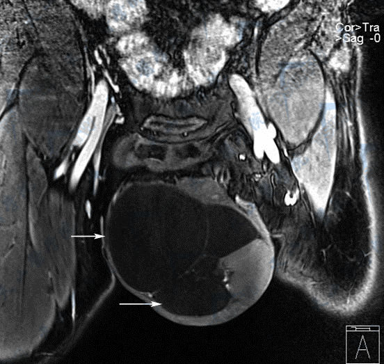 阴囊积液的CT及MRI磁共振现象图解