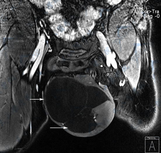 MIR冠状面T2WI图像，示阴囊积液（→）