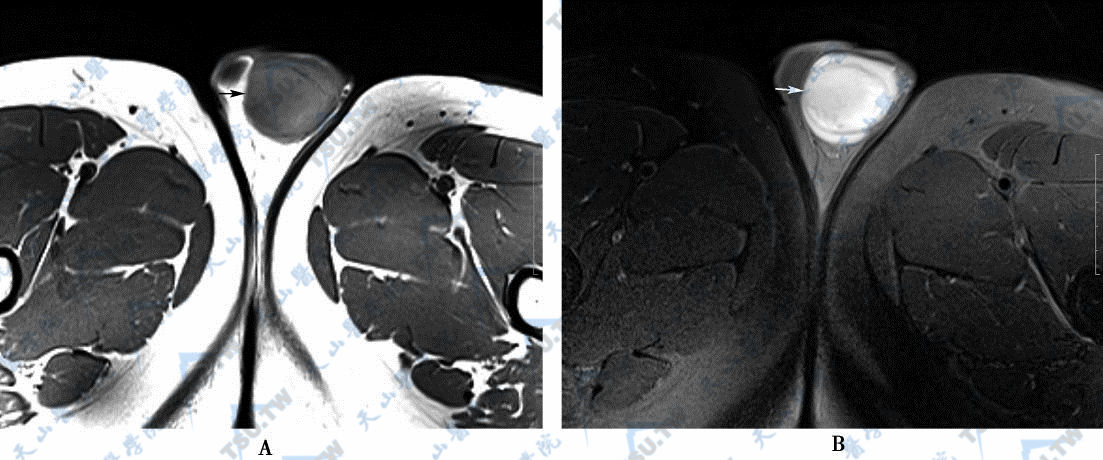 MR横断面平扫T2WI压脂图像，睾丸囊肿呈高信号