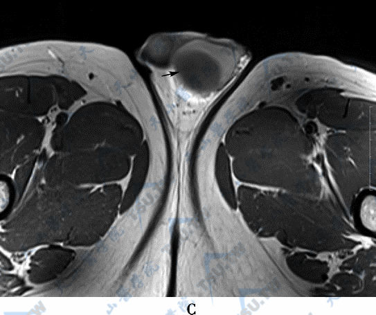 睾丸囊肿（testicle cyst）的CT与磁共振现象