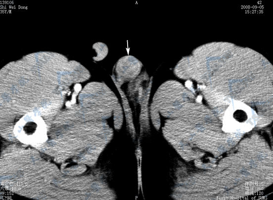 CT横断面增强扫描示右侧睾丸精原细胞瘤（→）