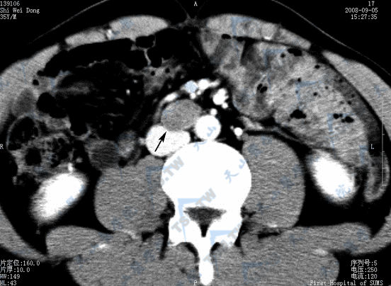 CT横断面增强扫描示睾丸精原细胞瘤并腹膜后淋巴结转移（→）