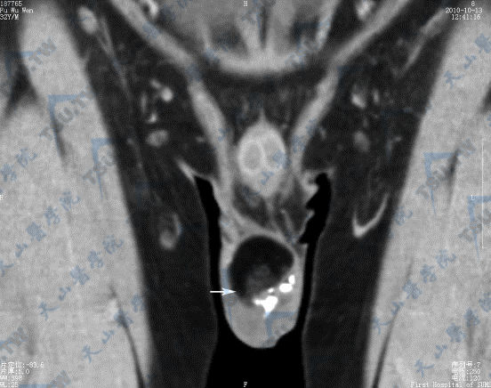 CT冠状位图示睾丸畸胎瘤（→），瘤内成分复杂，其中低密度为脂肪成分，高密度为骨化影