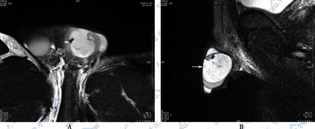 MR　T2WI矢状位图，示睾丸畸胎瘤（→），瘤内成分不一，其中低信号区为骨化影