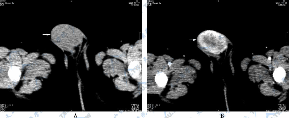 A．CT横断面平扫图，示睾丸卵黄囊瘤（→）　B．CT横断面增强扫描图，示睾丸卵黄囊瘤（→），增强扫描肿瘤明显不均匀强化
