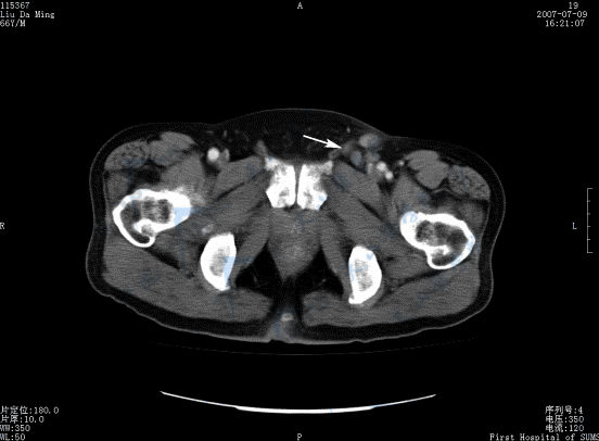 CT横断面增强扫描示Paget病并左侧腹股沟多个淋巴结增大