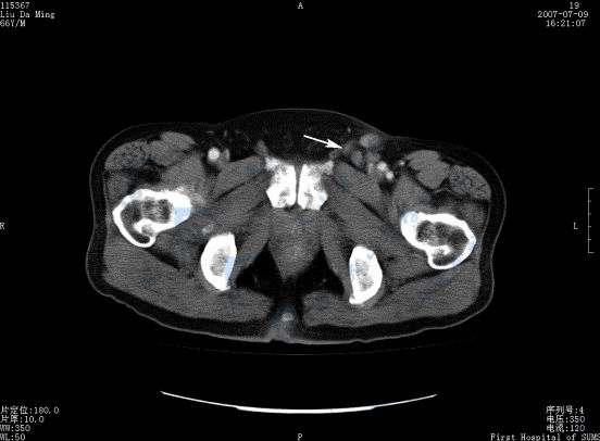 Paget病CT横断面增强扫描