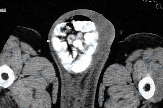 腹股沟斜疝（oblique inguinal hernia）CT现象