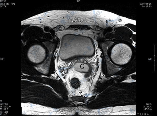 横断面T2WI示右侧精囊缺如，左侧精囊囊肿（C）