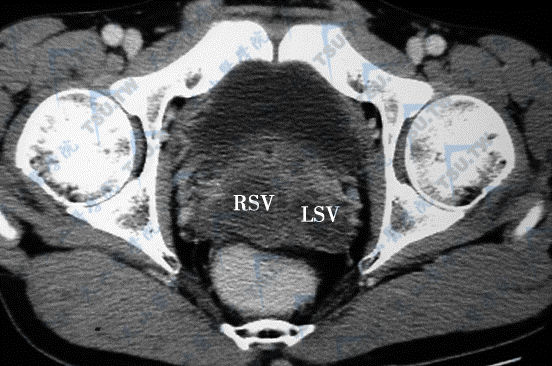 CT横断面增强扫描示精囊炎，双侧精囊不均匀增大（右精囊RSV，左精囊LSV）