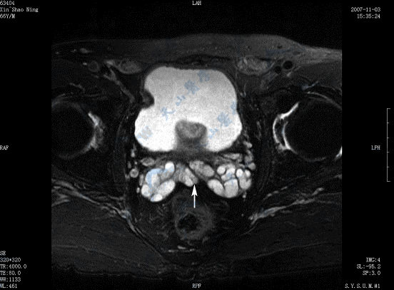 MR横断面T2WI脂肪抑制成像示慢性精囊炎，精囊囊腔扩张（→）、信号减低