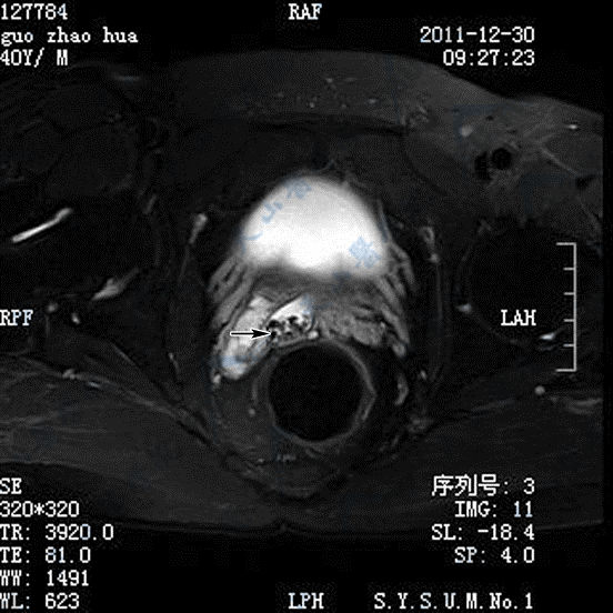 精囊结石的CT和MRI磁共振成像