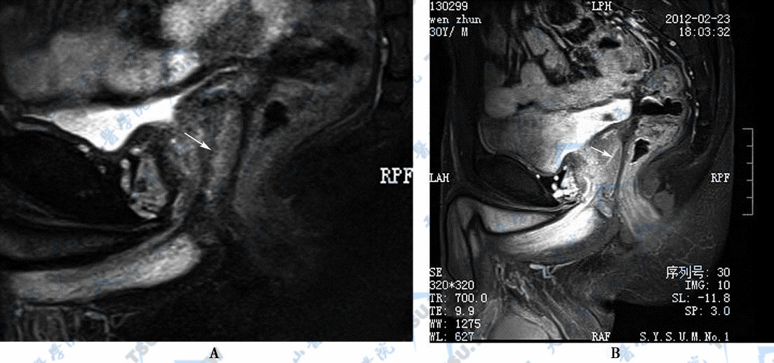 A．MR示射精管炎症，矢状位平扫T2WI脂肪抑制图，细管状高信号影为射精管管腔（→），周围为增厚的射精管壁　B．MR示射精管炎症，矢状位增强扫描T1WI脂肪抑制图，增厚的射精管壁由于炎症充血而明显强化（→）