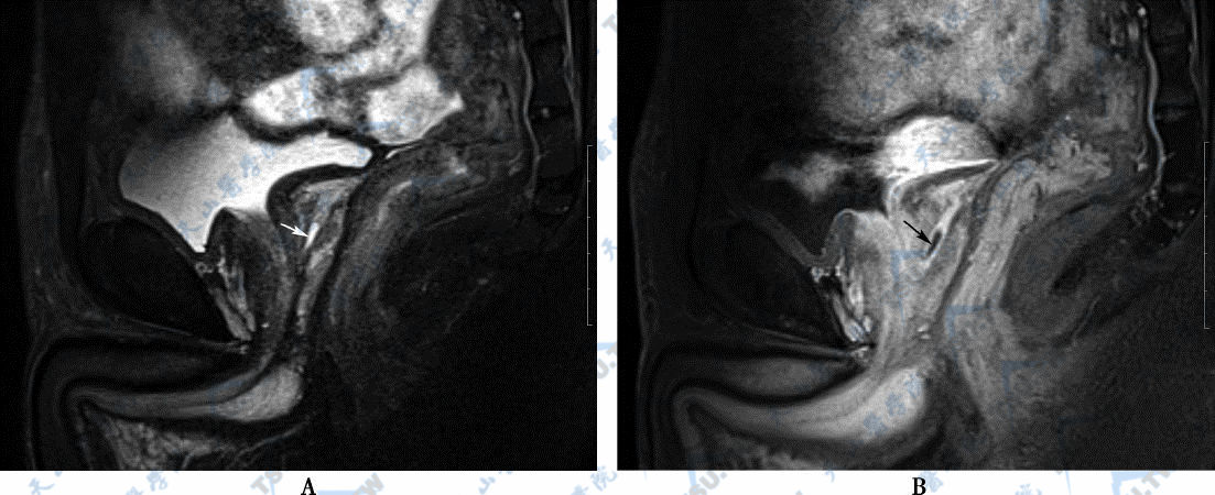 A．矢状位平扫T2WI脂肪抑制图，示扩张的射精管（→）　B．矢状位增强扫描T1WI脂肪抑制图，示射精管扩张、射精管壁由于炎症充血而明显强化（→）