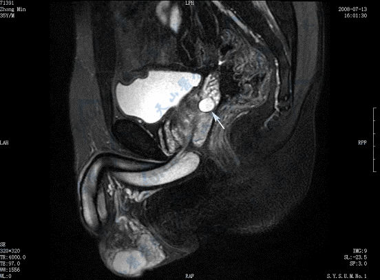 射精管：射精管炎、扩张、囊肿、结石的CT与磁共振成像
