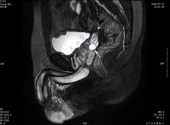 矢状面T2WI脂肪抑制成像示射精管囊肿（→）