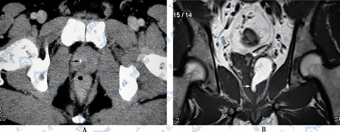 A．CT平扫轴位，示左侧射精管结石（→）　B．MR平扫冠状位T1WI图，示结石导致左侧射精管梗阻扩张（→），由于出血管腔呈高信号