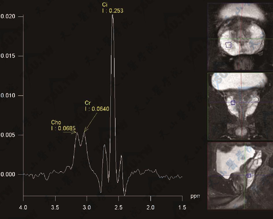 示正常前列腺外周带MRS谱线：Cit峰高耸，Cho、Cre峰较低，两者不能完全分离