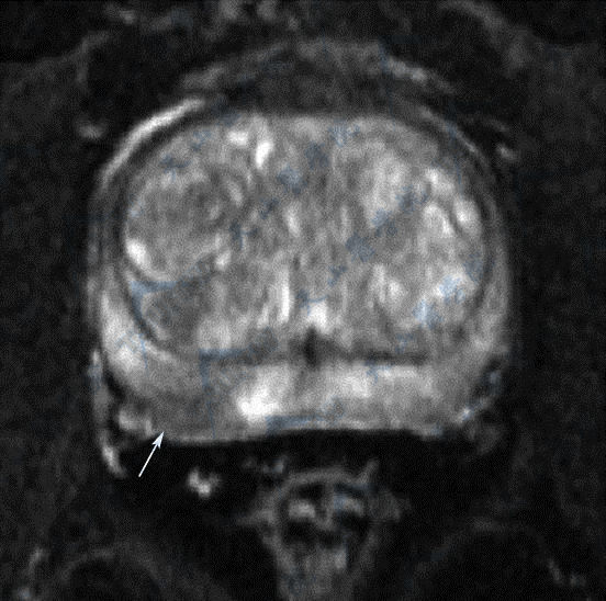 前列腺炎（prostatitis）MRI磁共振T2WI成像