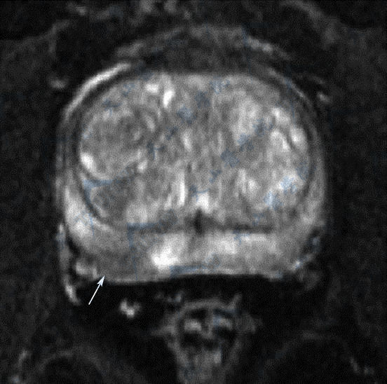 MR平扫横断面T2WI脂肪抑制成像示前列腺右侧外周带炎症（→）