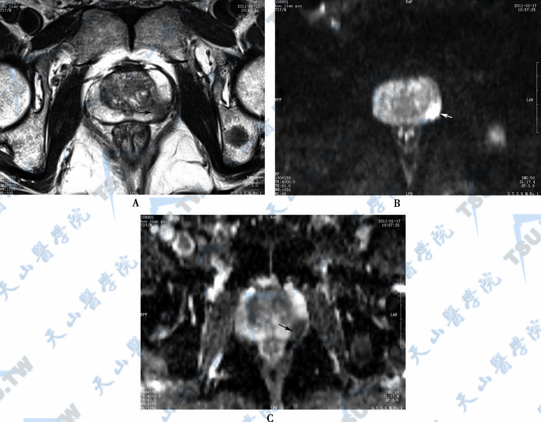 外周带前列腺癌，MR平扫轴位T2WI图，癌灶呈低信号