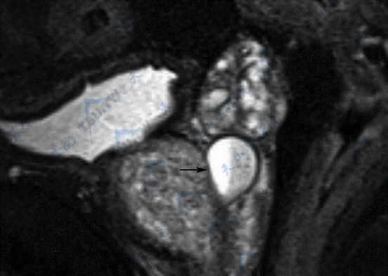 前列腺结核（prostatic tuberculosis）MR磁共振成像