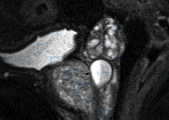 MR平扫矢状位T2WI脂肪抑制成像示前列腺苗勒氏囊肿（→）