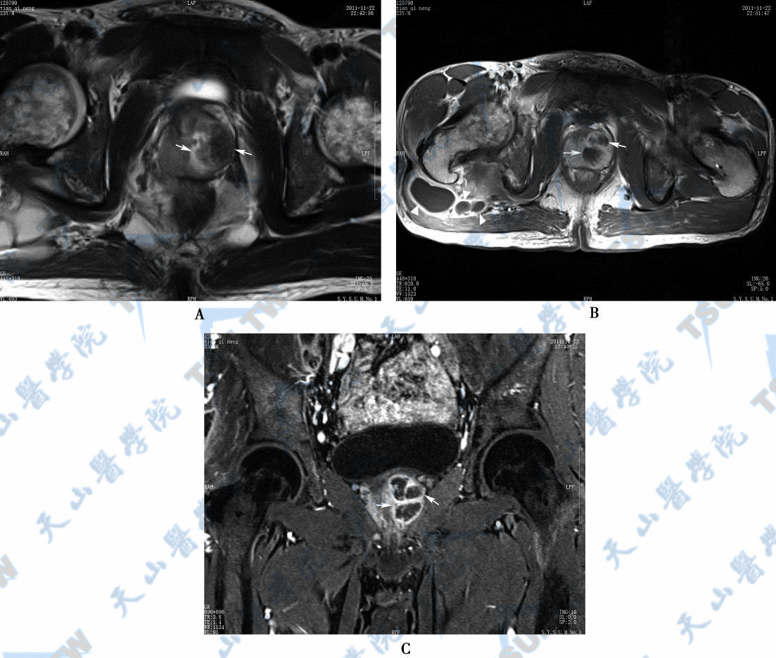 前列腺脓肿（prostatic abscess）MR磁共振成像