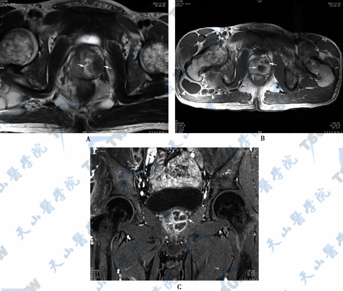 A．前列腺脓肿，MR平扫横断面T2WI，脓肿呈高／低混杂信号（→）　B．前列腺脓肿，横断面T1WI增强扫描，脓肿壁呈环状强化（→），患者右侧臀肌脓肿亦呈环状强化（Δ）　C．前列腺脓肿，增强扫描T1WI冠状位压脂序列图，示脓肿（→）