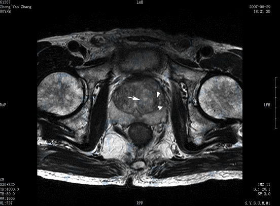 前列腺增生（prostatic hyperplasia）MRI磁共振成像