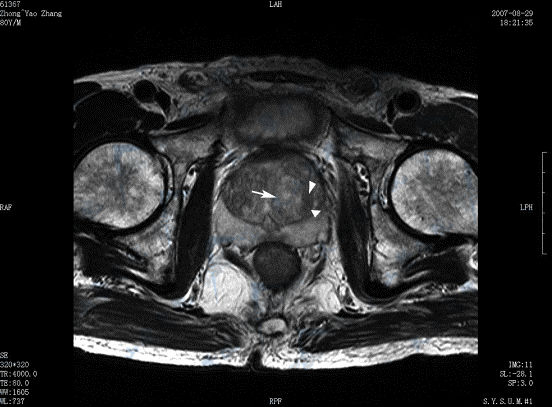 图 前列腺增生 Prostatic Hyperplasia Mri磁共振成像 男科学 天山医学院